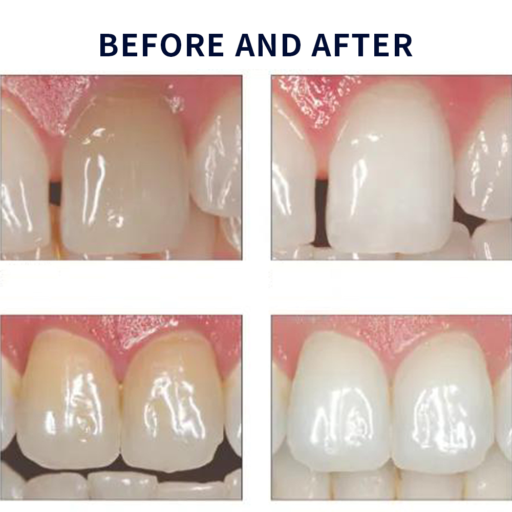 Opalescence Whitening 20% PF 2 - огляд і ціна Teeth Whitening Near Me